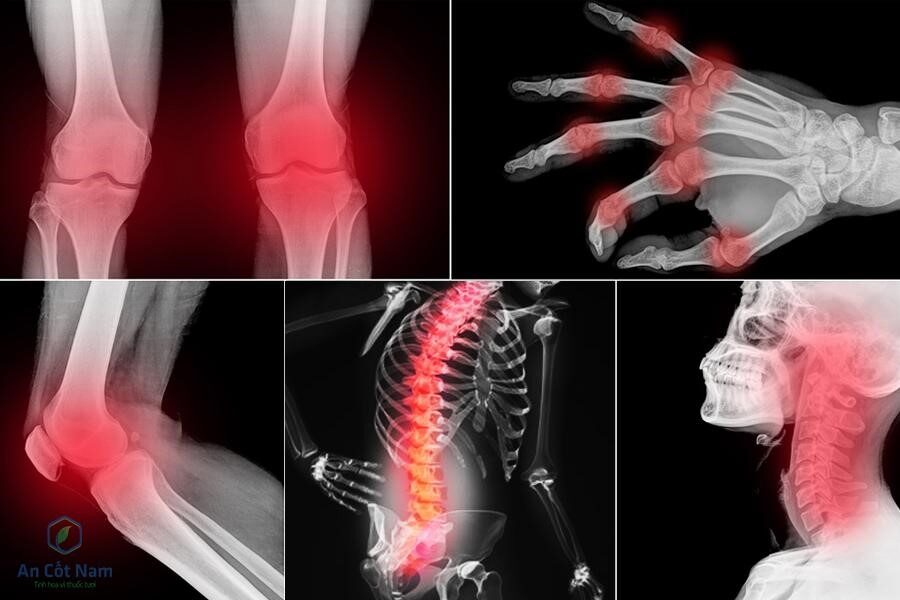 Đau Nhức Xương Khớp Uống Thuốc Gì?