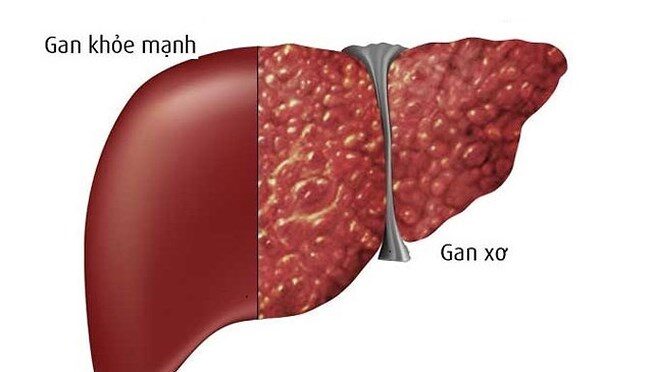 Gan Nhiễm Mỡ Nên Dùng Thảo Dược Gì?