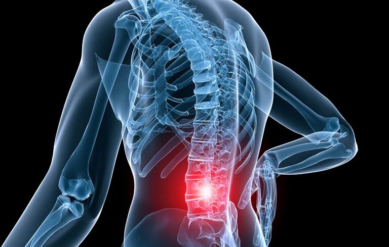 Thoái Hóa Cột Sống Điều Trị Bằng Đông Y Được Không?