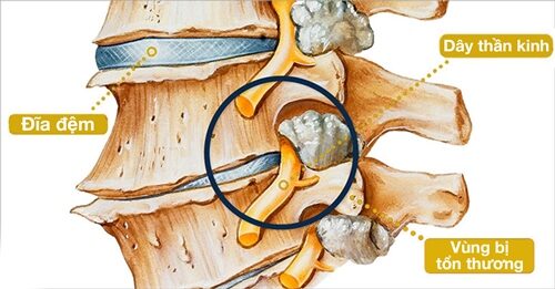 Thoái Hóa Cột Sống Điều Trị Bằng Đông Y Được Không?