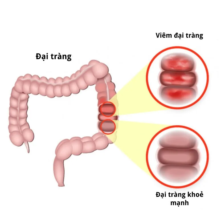 viem dai trang co nguy hiem khong 685509755ede2